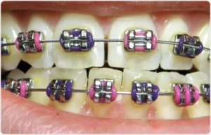 Read more about the article Cost of Dental (Teeth) Braces in South Africa